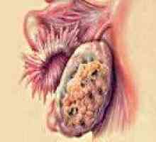 Przerzuty raka jajnika