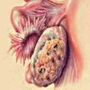 Przerzuty raka jajnika