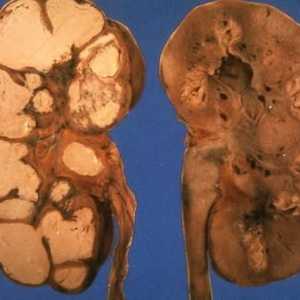 Gruźlica układu moczowo-płciowego (nephrotuberculosis)