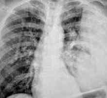 Abscessed zapalenie płuc