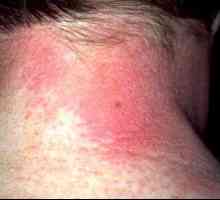 Alergiczne zapalenie skóry: objawy i leczenie