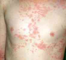 Atopowe zapalenie skóry: objawy i leczenie