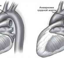 Tętniak aorty