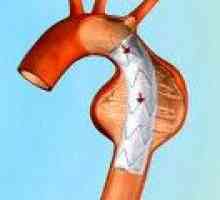 Tętniak aorty łuku