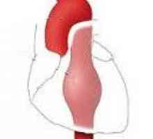 Tętniak aorty piersiowej zstępującej