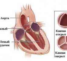 Niewydolność aorty (aortalnej)