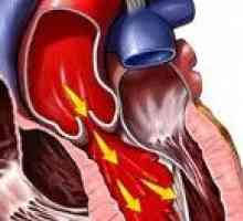 Niewydolność zastawki aortalnej