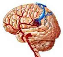 Malformacje tętniczo mózgu