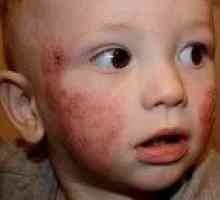 Atopowe zapalenie skóry u dzieci