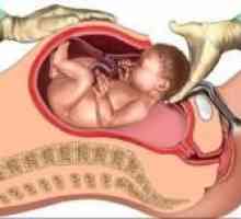 Ciąży i porodu blizną macicy po cięciu, usuwanie mięśniaków