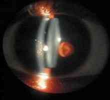 Biomicroscopy oczy