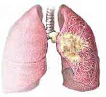 Centralny rak płuc