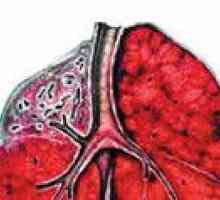 Marskością wątroby, gruźlica płuc