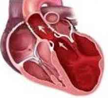 Kardiomiopatia rozstrzeniowa