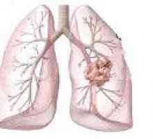 Hamartoma płuc