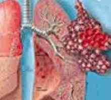 Krwotoczne zapalenie płuc