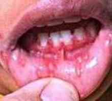Opryszczkowe zapalenie jamy ustnej u dzieci