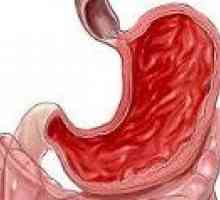 Rozrost błony śluzowej żołądka