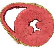 Przerost mięśnia lewej komory serca