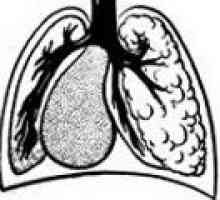 Niedorozwój płuc