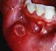 Przewlekłe zapalenie jamy ustnej