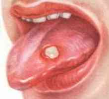 Wrzodziejące zapalenie jamy ustnej