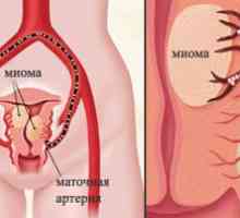 Embolizacji tętnicy macicznej (EMA), mięśniak macicy