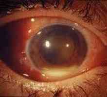 Zapalenie wnętrza gałki ocznej
