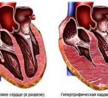 Kardiomiopatia
