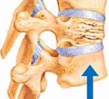 Kifoplastyka leczenie wertebroplastyki złamania trzonu kręgu kompresji