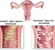 Coleitis (zapalenie pochwy) u mężczyzn i kobiet