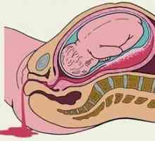 Krwawienie w czasie ciąży we wczesnych i późnych stadiach