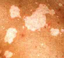 Chromophytosis: obraz, leczenie