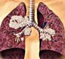 Drobnokomórkowy rak płuca