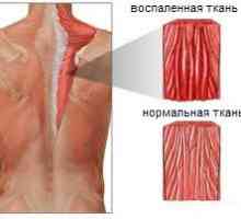 Mięśnie zapalenie mięśni grzbietu i karku