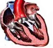 Niedomykalność zastawki aortalnej oraz defekt