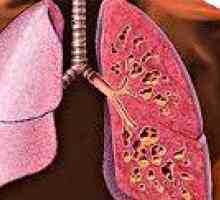 Mukowiscydoza płuc