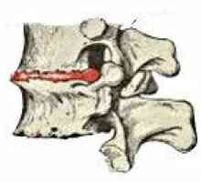 Osteochondroza