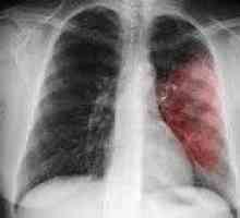 Ostre zapalenie płuc