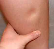 Obrzęk nóg w czasie ciąży