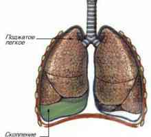 Zapalenie opłucnej