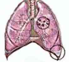 Płaskonabłonkowy rak płuca