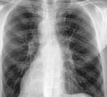 Objawy zapalenia płuc, objawy, leczenie zapalenia płuc płuc
