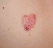 Rak skóry: objawy, leczenie