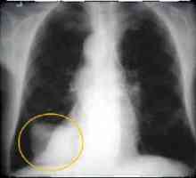 Rak płuca: objawy, objawy, leczenie