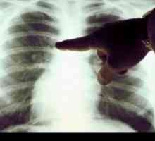 Rak płuc