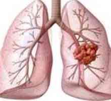 Rak płuc