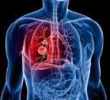 Nawrót raka płuc
