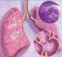Sarkoidoza płucna