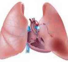 Niewydolności sercowo-płucnej